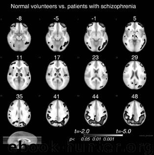 2010 - Secondary Schizophrenia by Sachdev & Keshavan