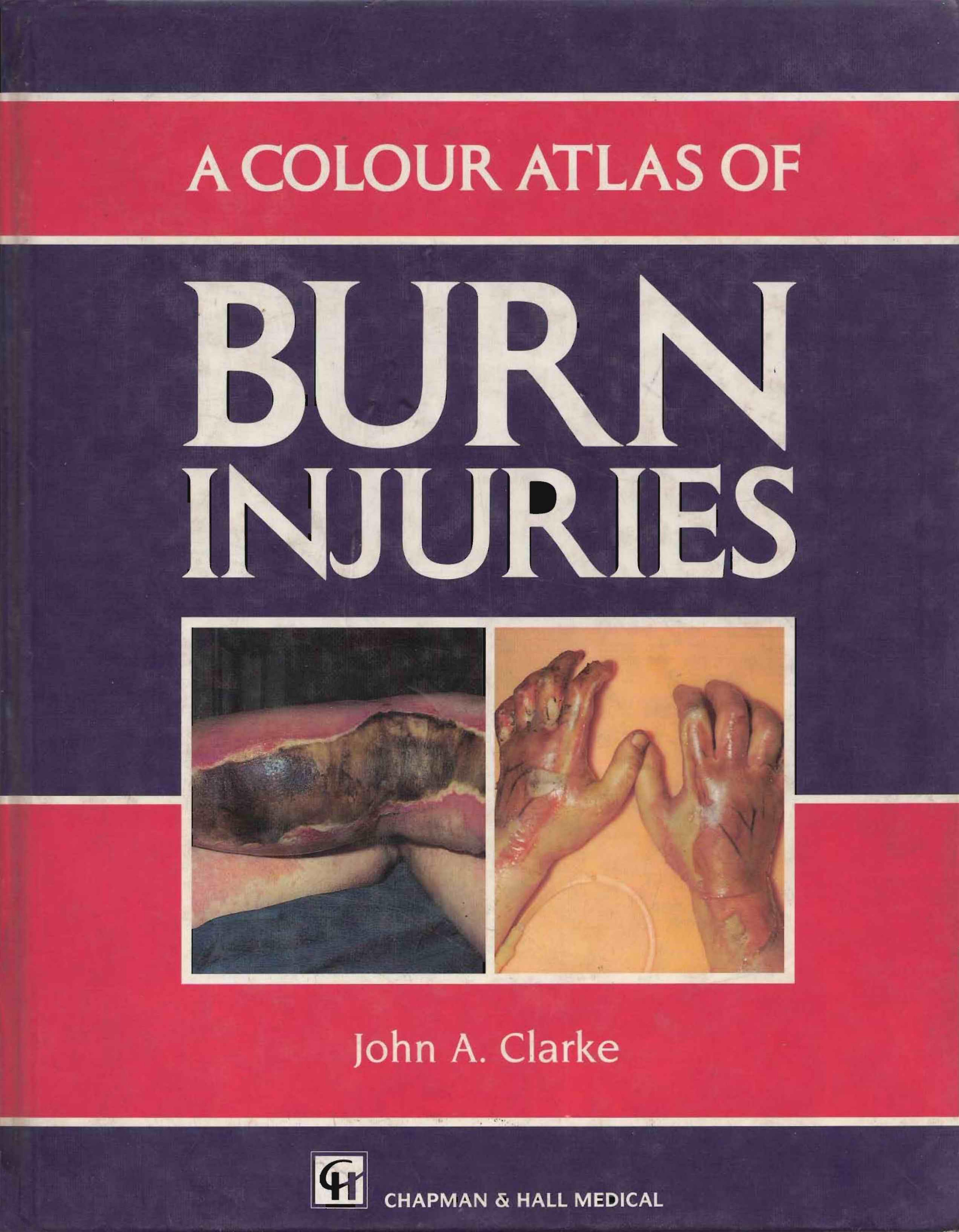 A Colour Atlas of Burn Injuries (Chapman & Hall Medical Atlas Series, 9) by John A. Clarke