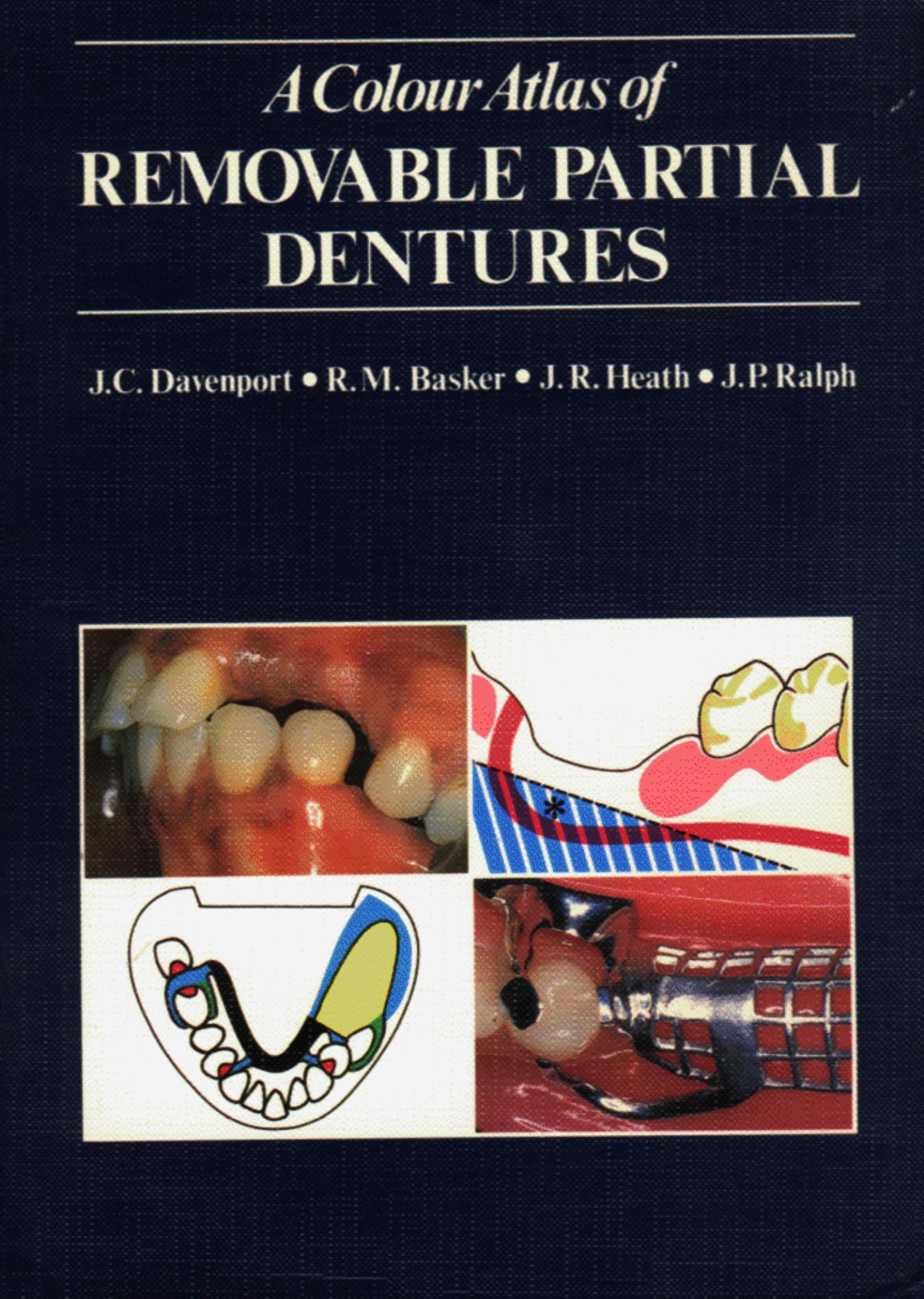 A Colour Atlas of Removable Partial Dentures by F. Peter Lisowski