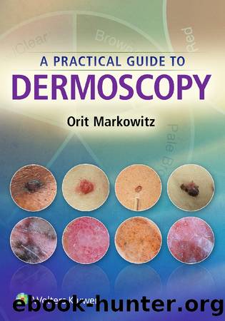 A Practical Guide to Dermoscopy by Orit Markowitz