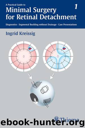 A Practical Guide to Minimal Surgery for Retinal Detachment: 1 by Ingrid Kreissig
