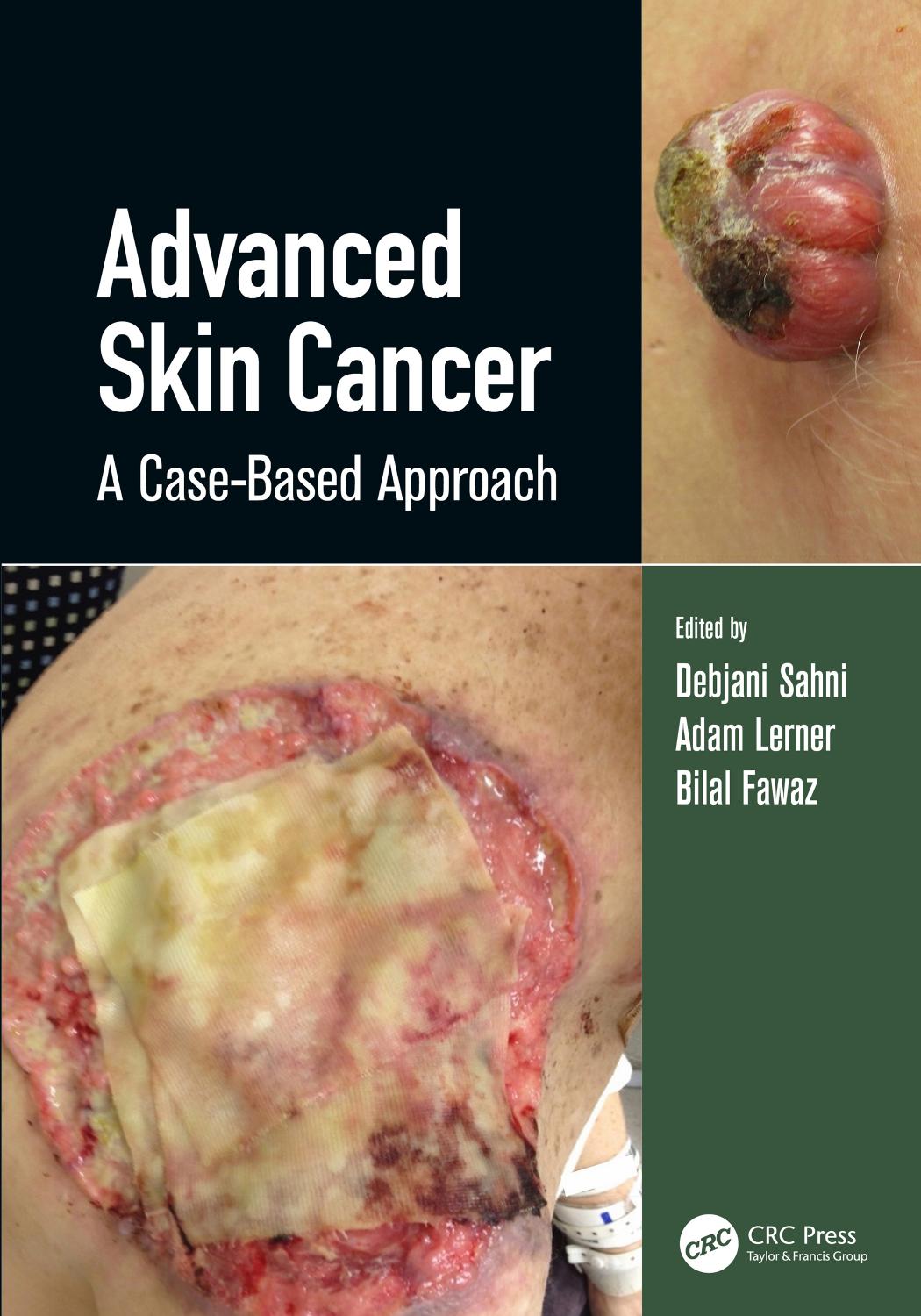 Advanced Skin Cancer; A Case-Based Approach by Debjani Sahni