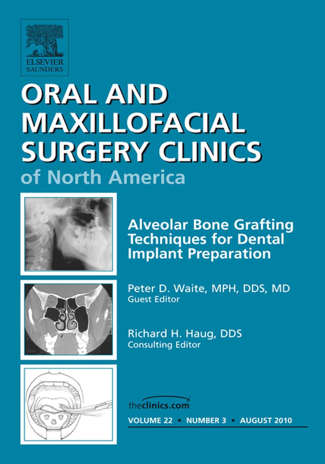 Alveolar Bone Grafting Techniques in Dental Implant Preparation, An Issue of Oral and Maxillofacial Surgery Clinics by Peter D. Waite