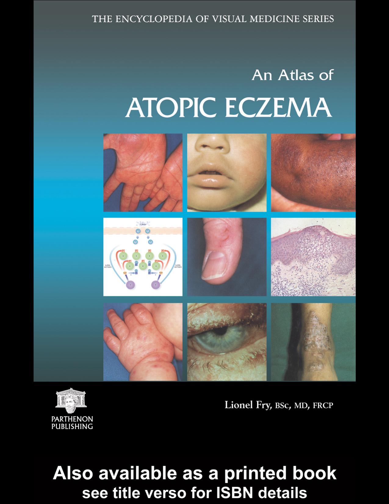 An Atlas of Atopic Eczema (Encyclopedia of Visual Medicine Series) by Lionel Fry