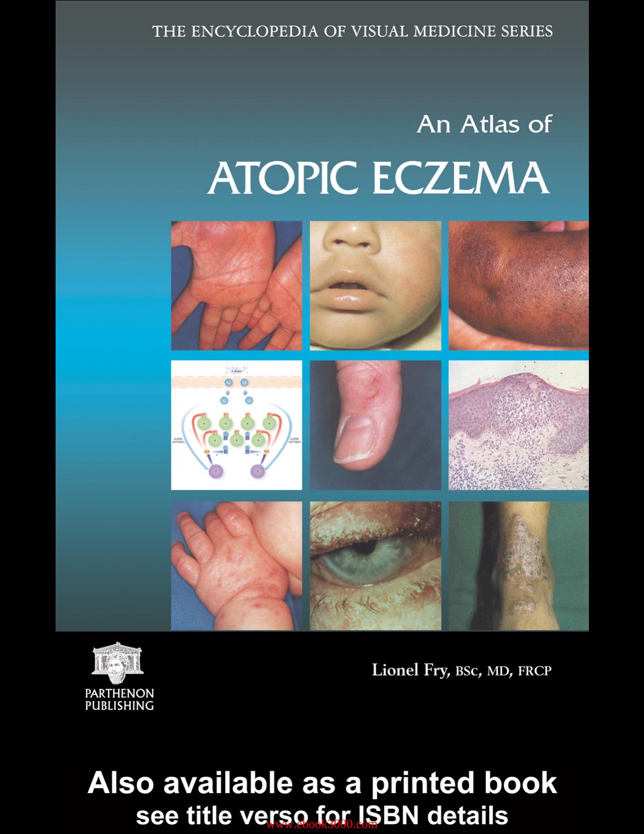 An Atlas of Atopic Eczema (Encyclopedia of Visual Medicine Series) by Unknow