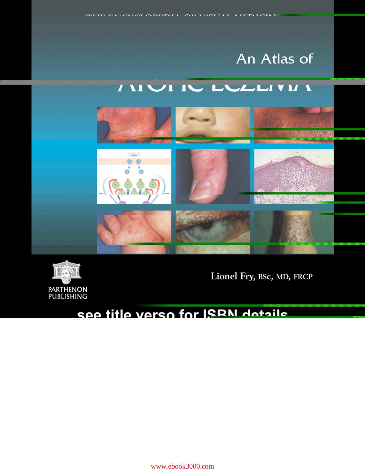 An Atlas of Atopic Eczema: The Encyclopedia of Visual Medicine Series by Lionel Fry and Charles N.Ellis