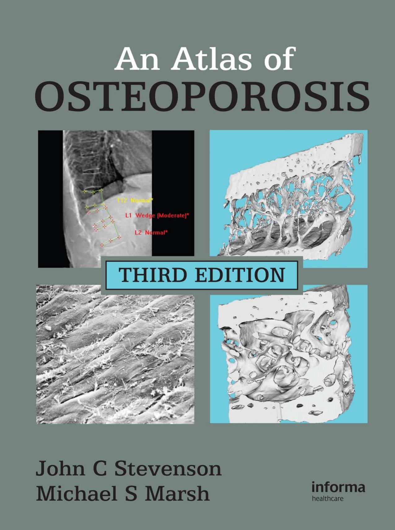 An Atlas of Osteoporosis, Third Edition by John C. Stevenson Michael S. Marsh