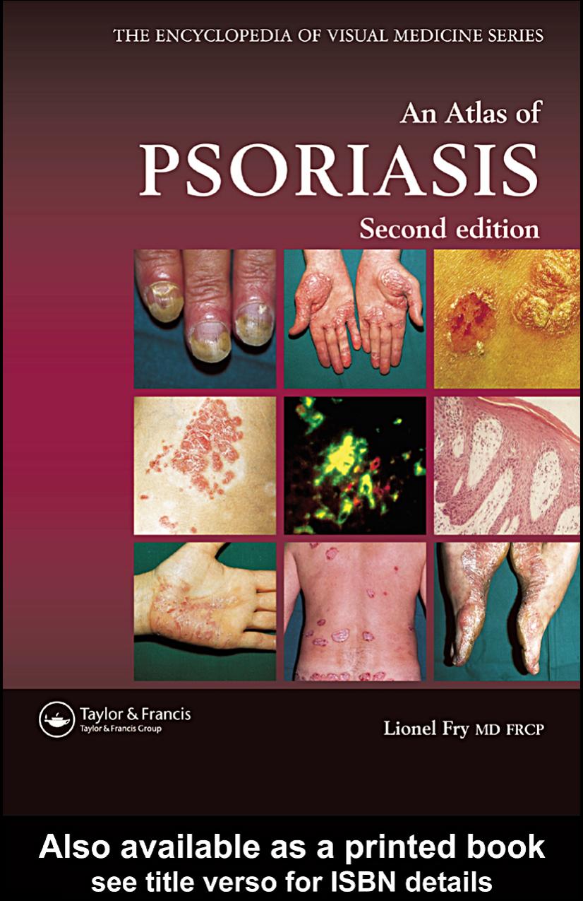 An Atlas of Psoriasis, Second Edition by Lionel Fry