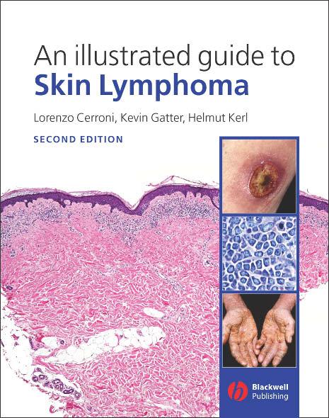 An Illustrated Guide to Skin Lymphoma by Lorenzo Cerroni Kevin Gatter Helmut Kerl