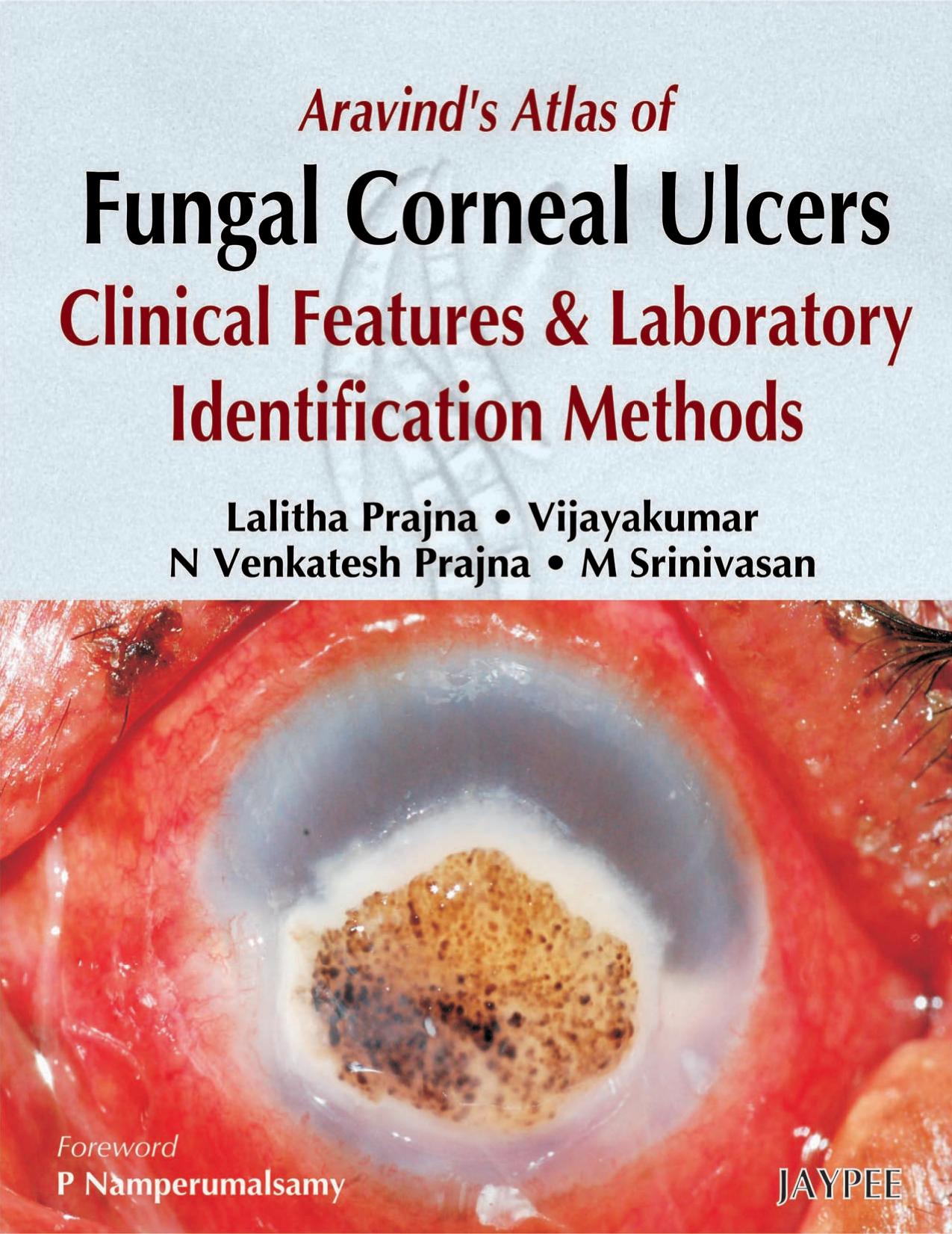 Arvinds Atlas of Fungeal Conreanl Ulcers Clinical Features and Laboratory Identificatiion Methods by Lalitha Prajna Vijayakumar N Venkatesh Prajna M Srinivasan