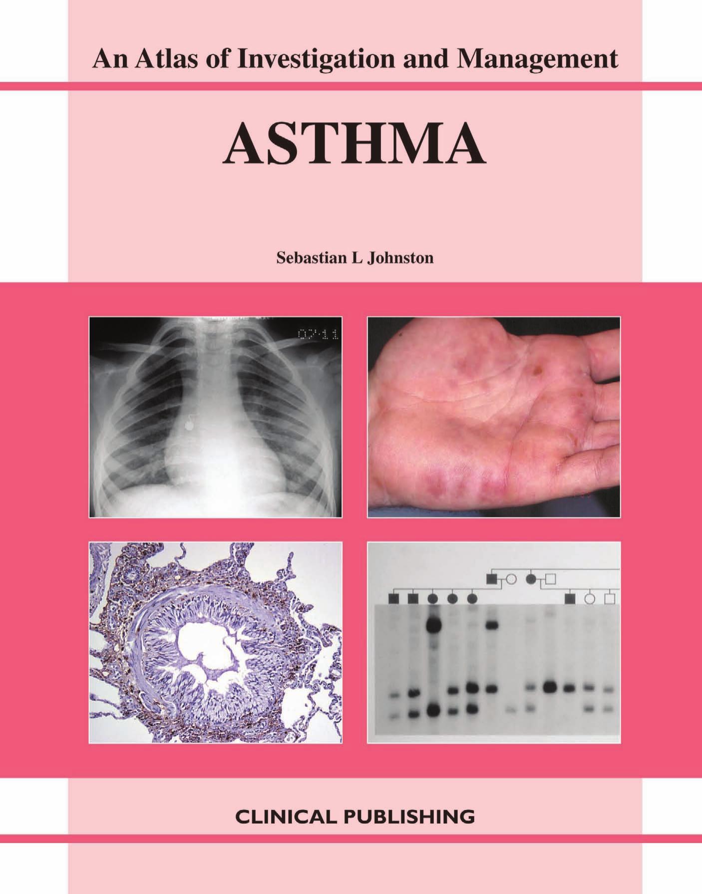 Asthma: An Atlas of Investigation and Diagnosis by Sebastian L. Johnston