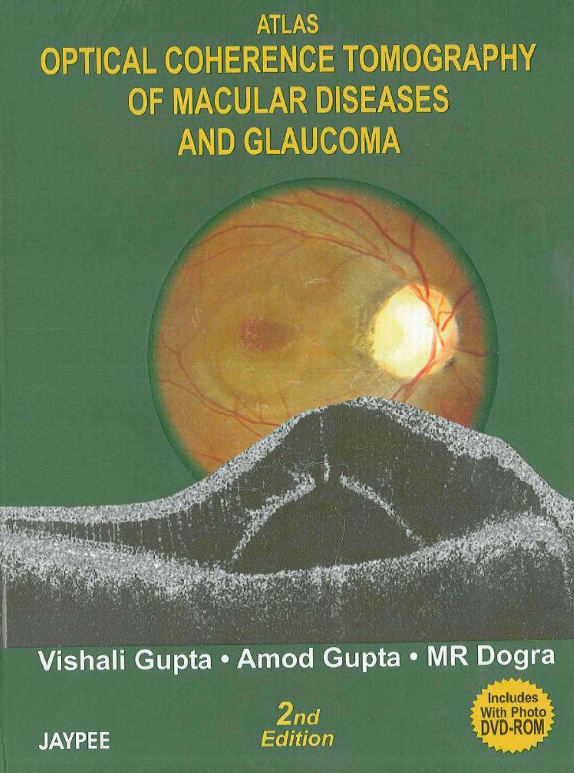 Atlas Optical Coherence Tomography of Macular Diseases and Glaucoma by Unknow
