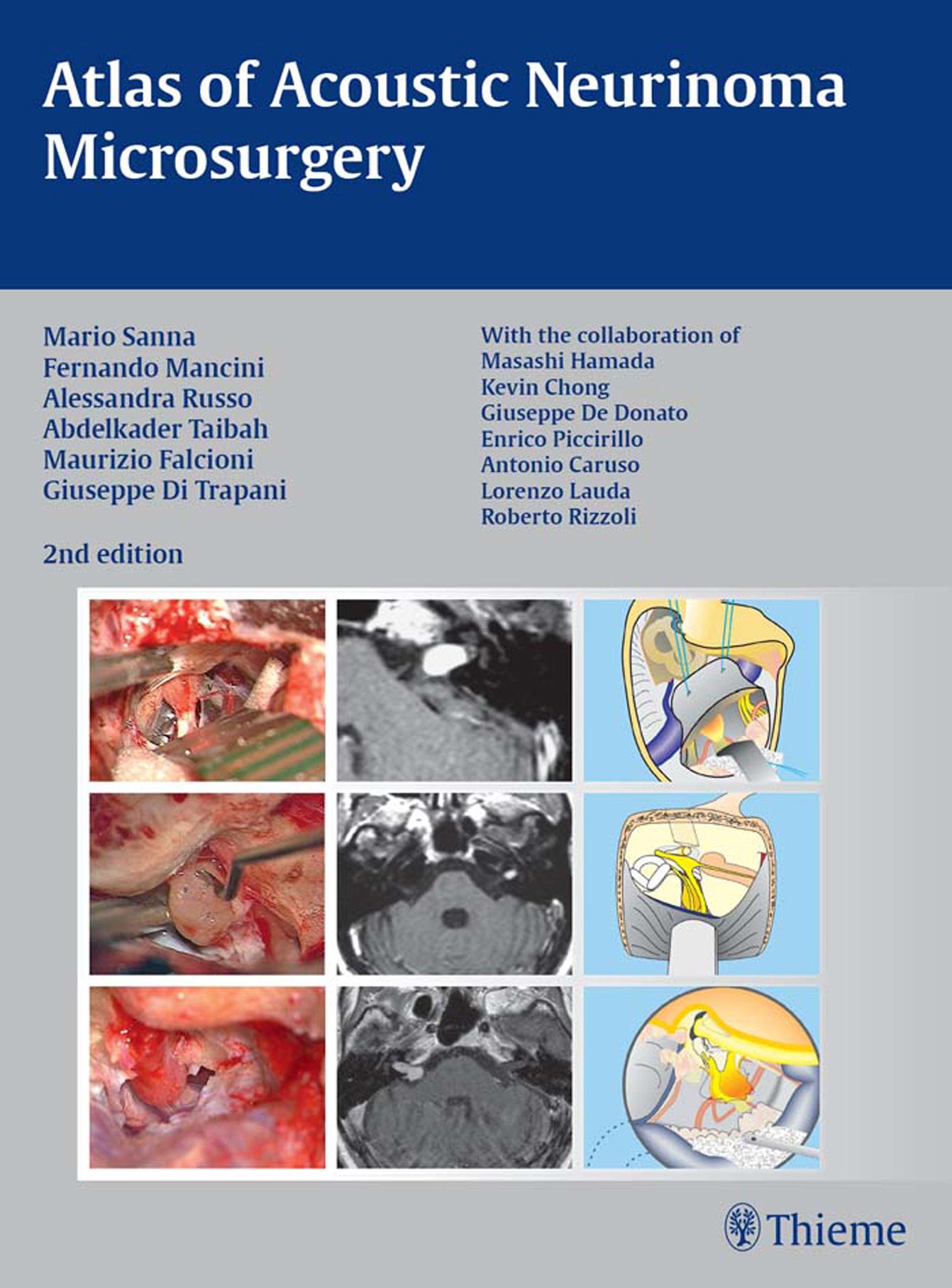 Atlas of Acoustic Neurinoma Microsurgery: . Zus.-Arb.: Mario Sanna Essam Saleh, Benedict Panizza, Alexandra Russo, Abdel TaibahWith the collaboration of Refik Caylan, Fernando Mancini by unknow