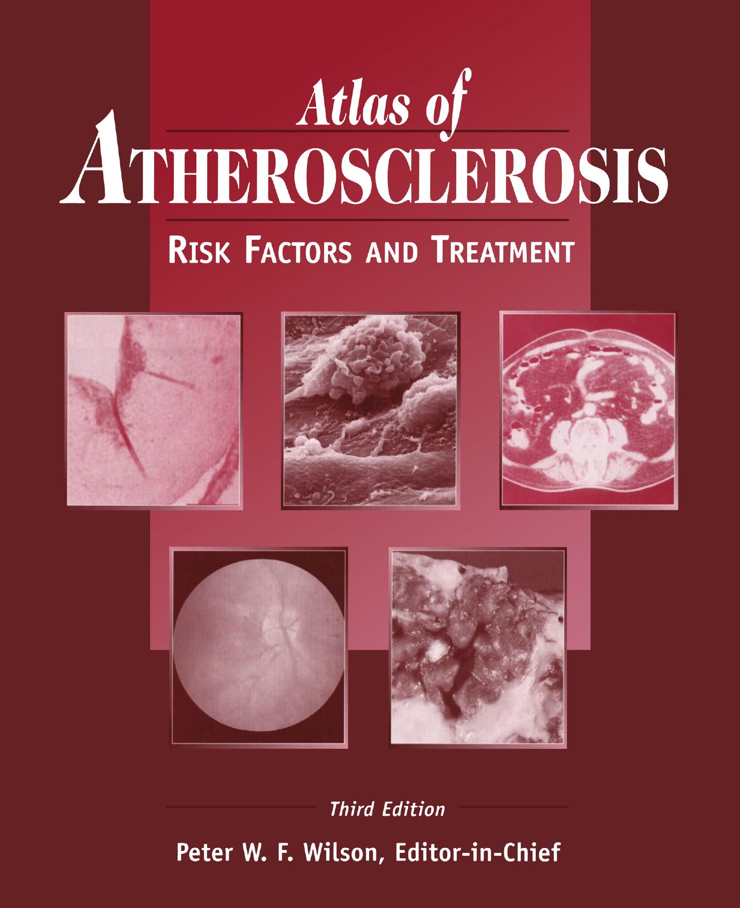 Atlas of Atherosclerosis: Risk Factors and Treatment by Michael B. Gravanis (auth.) Peter W. F. Wilson MD (eds.)