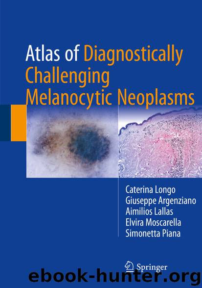 Atlas of Diagnostically Challenging Melanocytic Neoplasms by Caterina Longo & Giuseppe Argenziano & Aimilios Lallas & Elvira Moscarella & Simonetta Piana