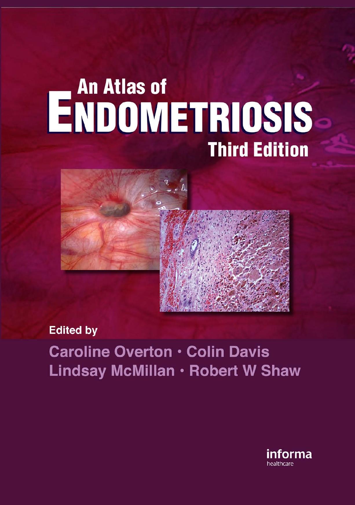 Atlas of Endometriosis by Unknown