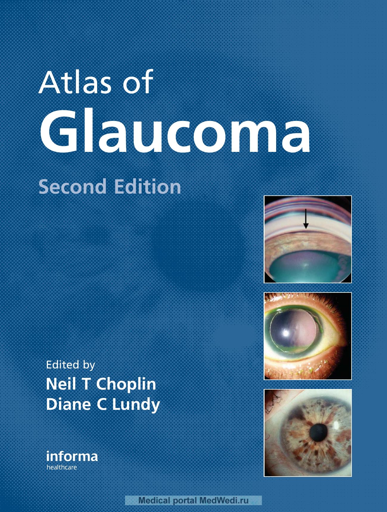 Atlas of Glaucoma by Choplin N.T. Lundy D.S