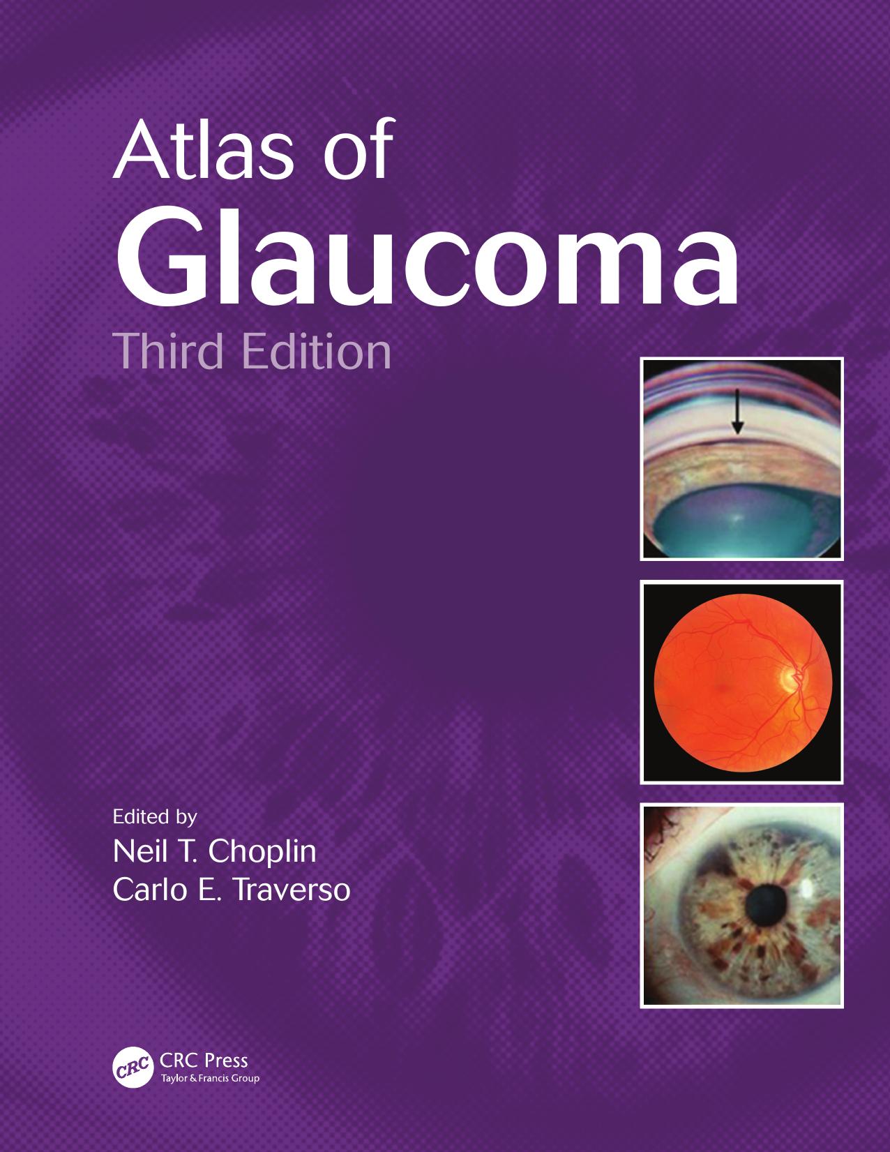 Atlas of Glaucoma, Third Edition by Unknow