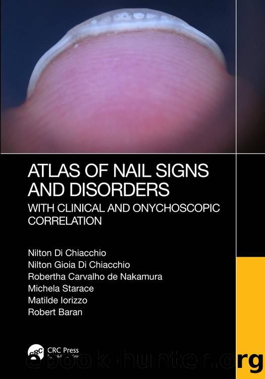 Atlas of Nail Signs and Disorders with Clinical and Onychoscopic Correlation by unknow