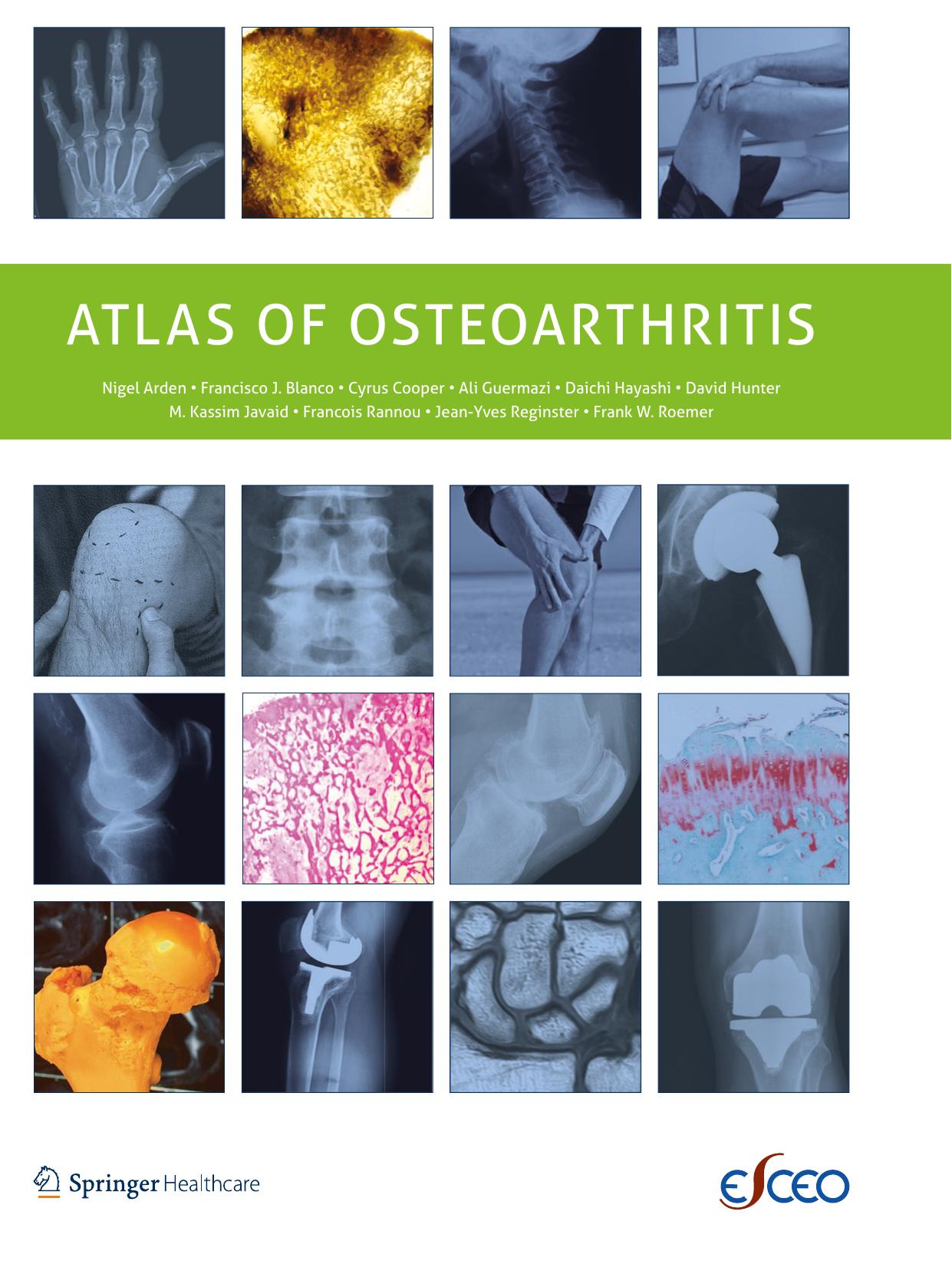 Atlas of Osteoarthritis by unknow