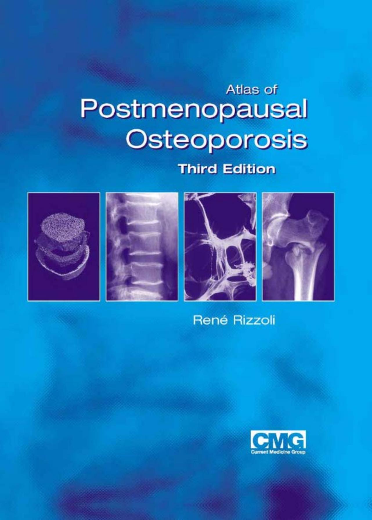 Atlas of Postmenopausal Osteoporosis, 3rd Edition by René Rizzoli