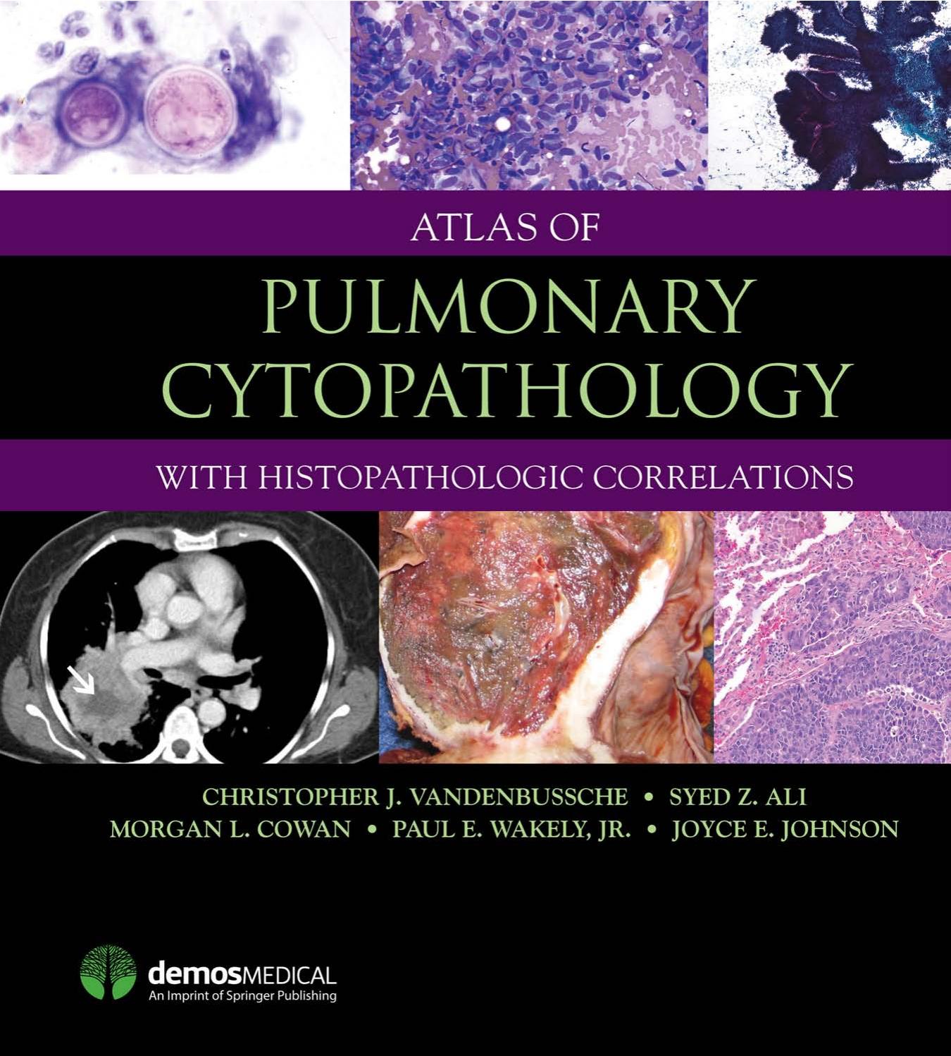 Atlas of Pulmonary Cytopathology by Syed Ameer Ali; Anil Parwani; Yener Erozan; Dorothy Rosenthal