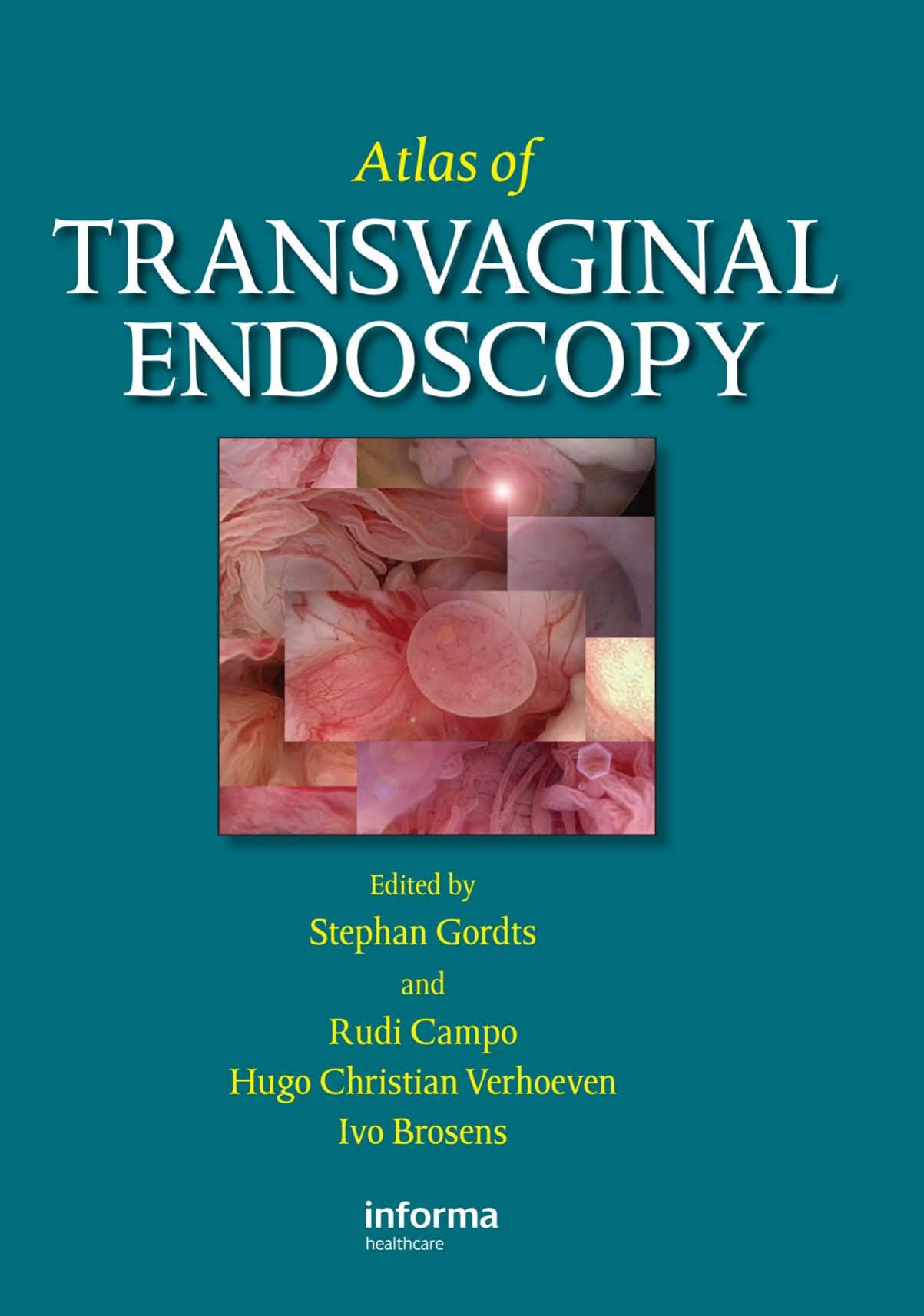 Atlas of Transvaginal Endoscopy by Stephen Gordts Hugo C. Verhoeven Rudi Campo Ivo Brosens