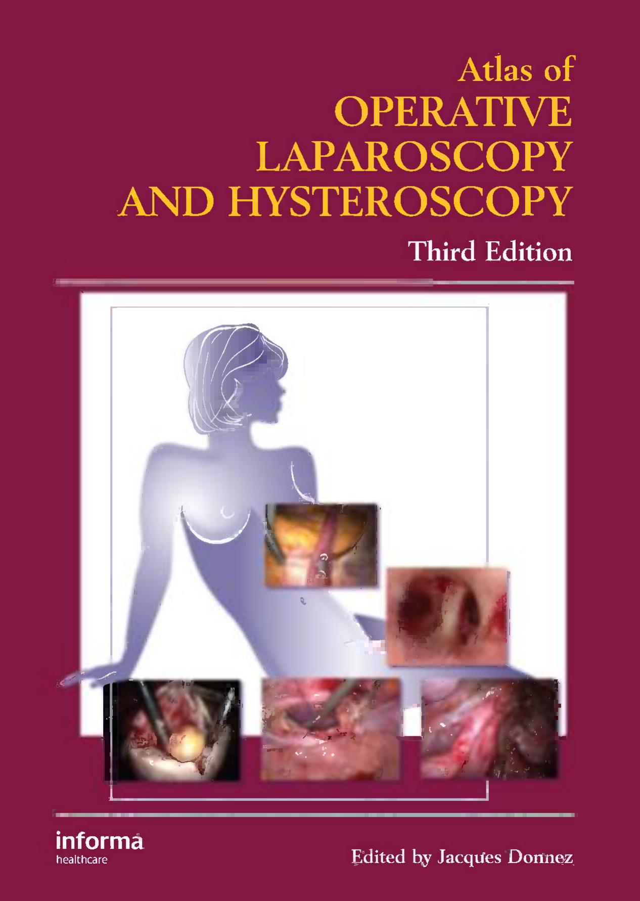 Atlas of operative laparoscopy and hysteroscopy by J Donnez