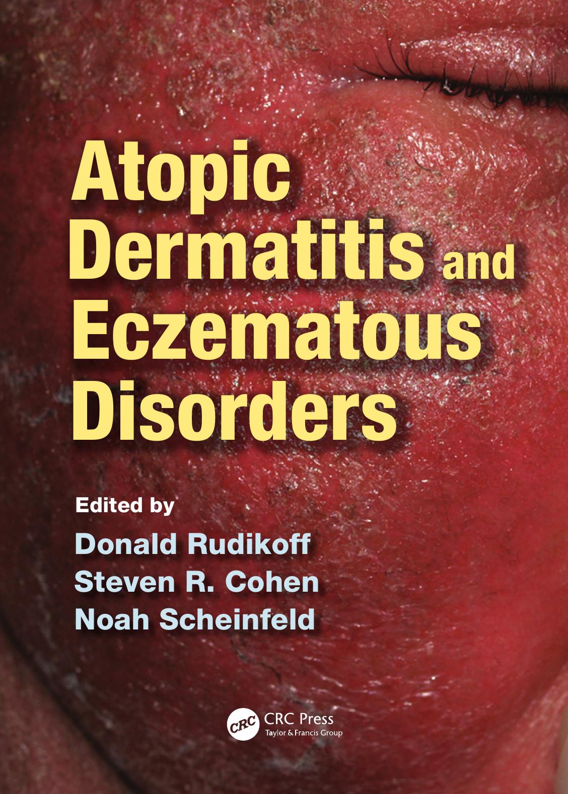 Atopic Dermatitis and Eczematous Disorders by Donald Rudikoff; Steven R Cohen; Noah Scheinfeld
