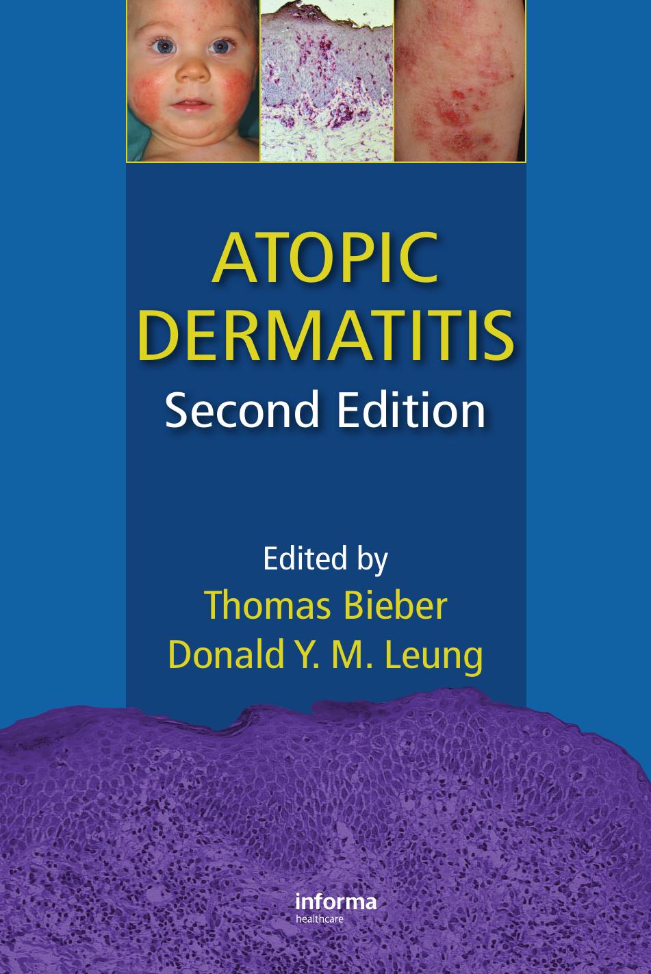 Atopic dermatitis by Leung Donald Y. M.; Bieber Thomas