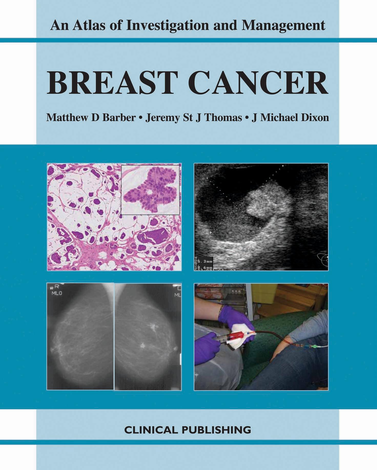 Breast Cancer: An Atlas of Investigation and Management (Atlases of Investigation and Management) by Matthew D. Barber Jeremy St. J. Thomas J. Michael Dixon