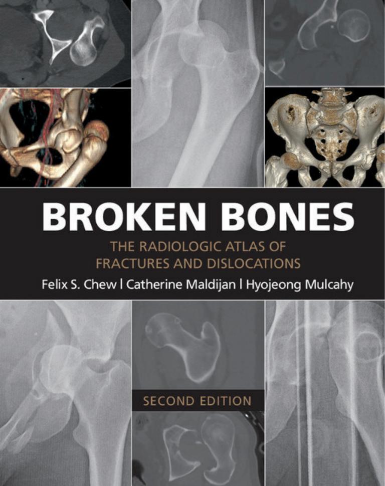Broken Bones: The Radiologic Atlas of Fractures and Dislocations, 2nd Edition by Unknow