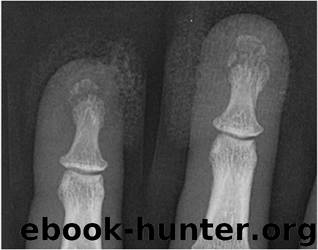 Broken Bones: The X-Ray Atlas of Fractures by Chew Felix S. & Hyojeong Mulcahy & Christin M. Brown