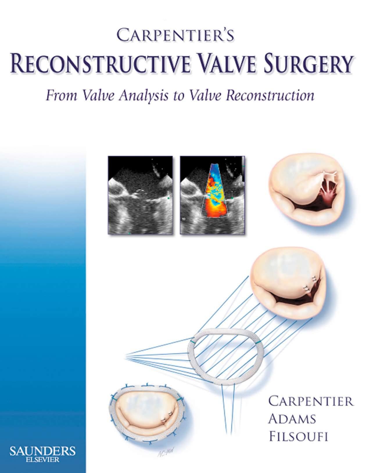 Carpentierâs Reconstructive Valve Surgery by Alain Carpentier David H. Adams Farzan Filsoufi