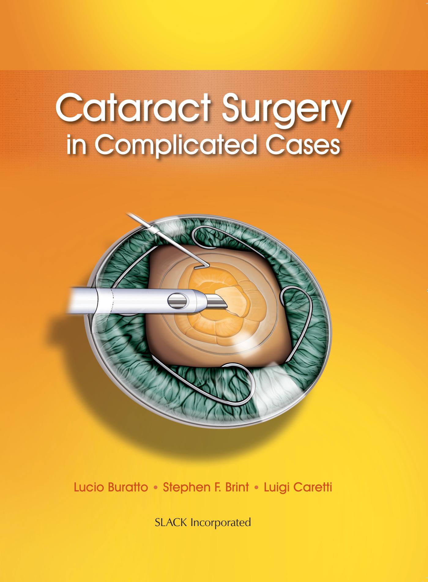 Cataract Surgery in Complicated Cases by Lucio Buratto MD Stephen Brint MD Luigi Caretti MD