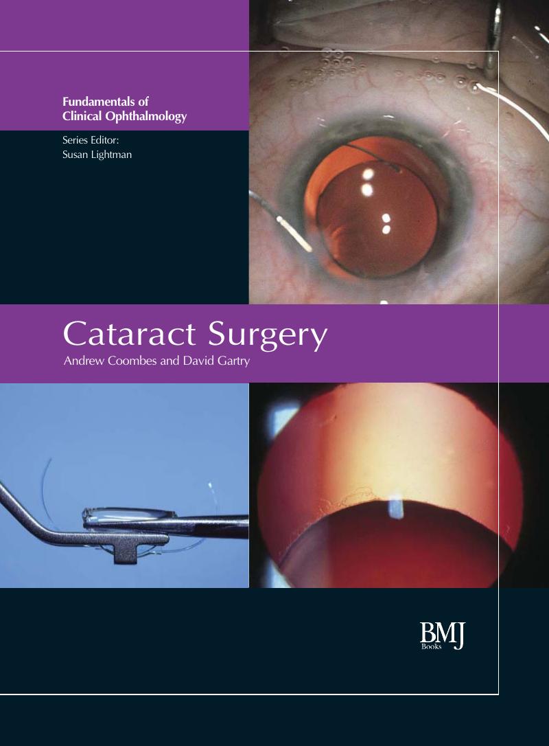 Cataract Surgery: FCO Series by Andrew Coombes David Gartry