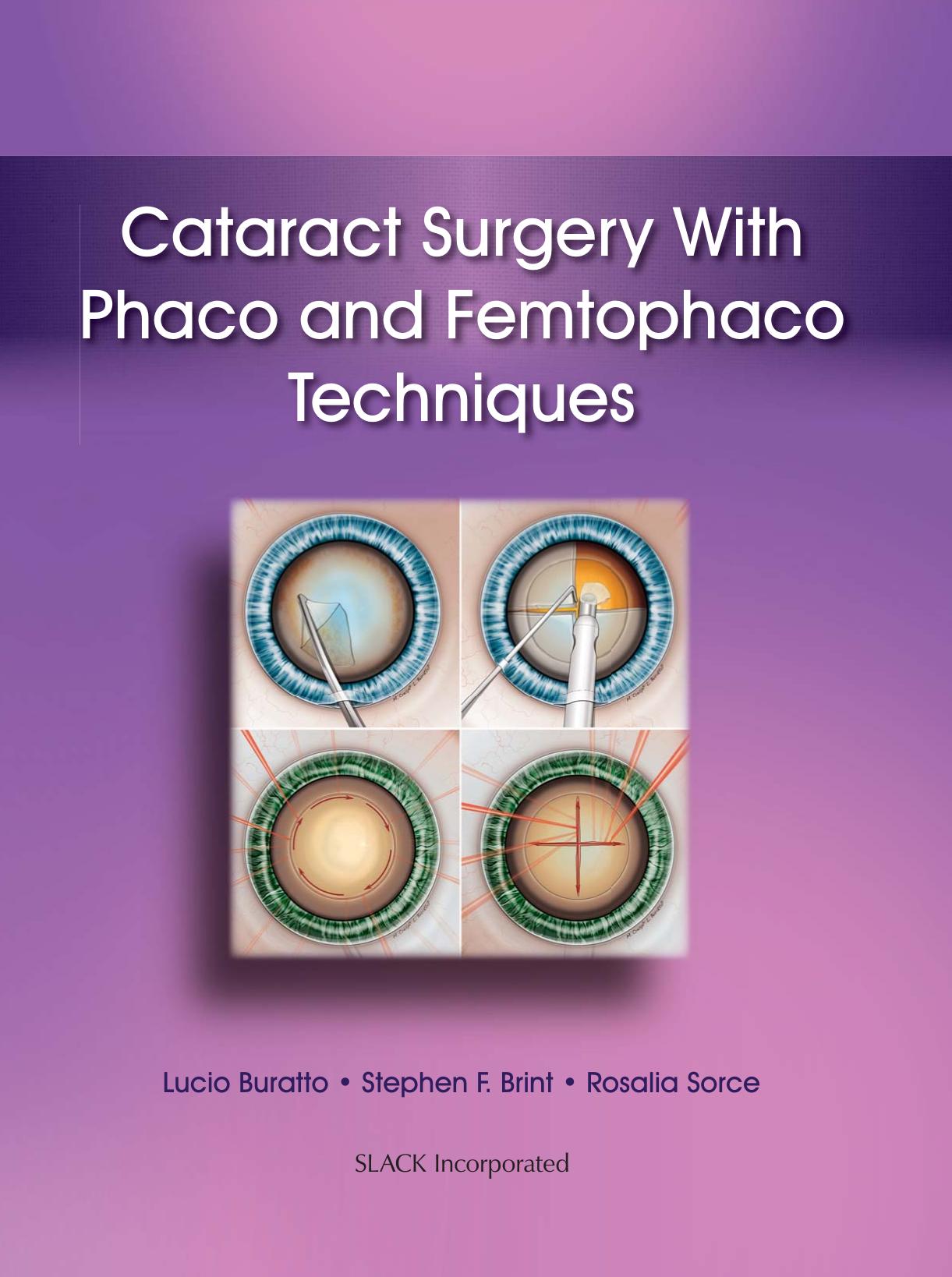 Cataract surgery phaco and femtophaco techniques by Brint Stephen;Buratto Lucio;Burrato Lucio;Crespi Massimiliano;Sorce Rosalia