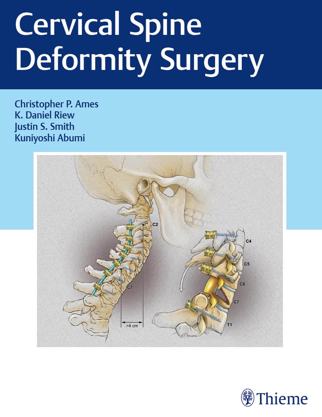 Cervical Spine Deformity Surgery by Unknow