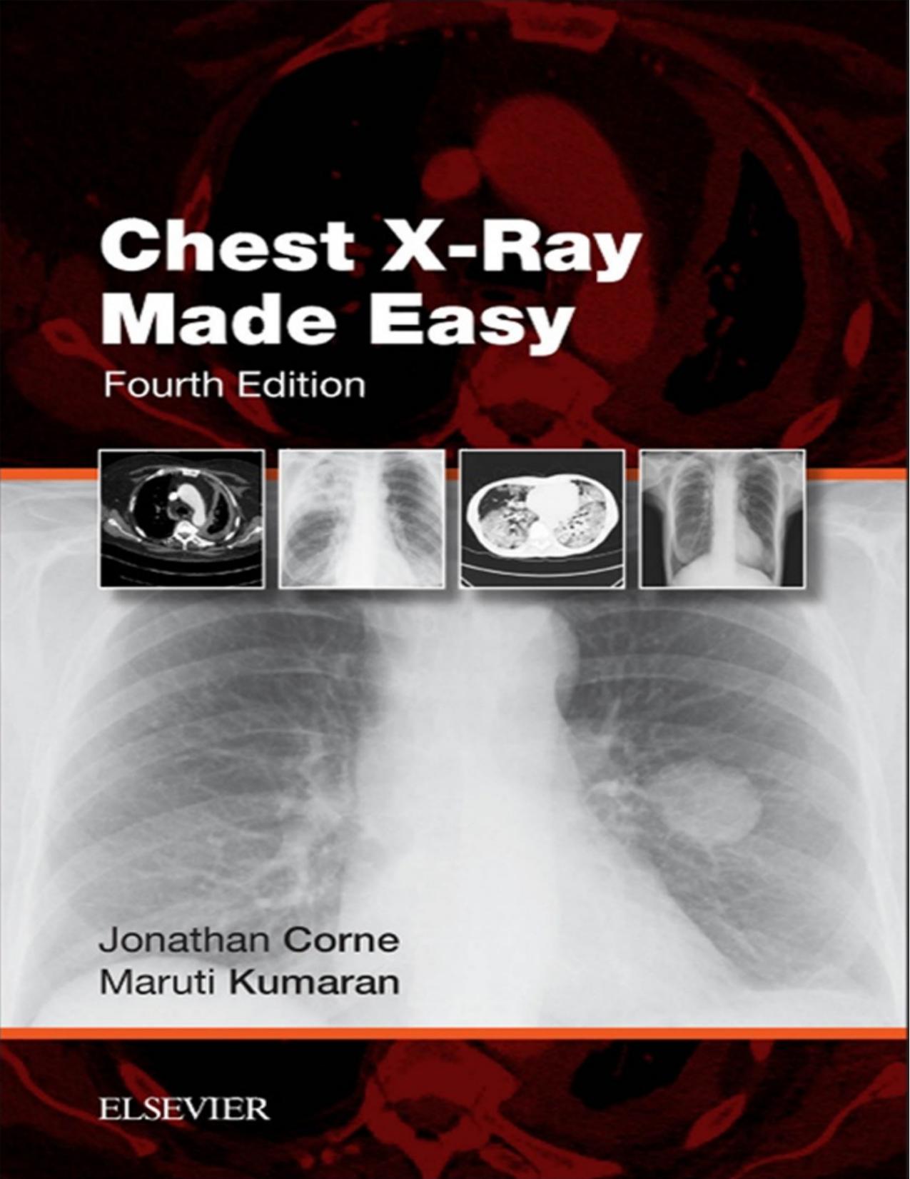 Chest X-Ray Made Easy by Jonathan Corne Maruti Kumaran