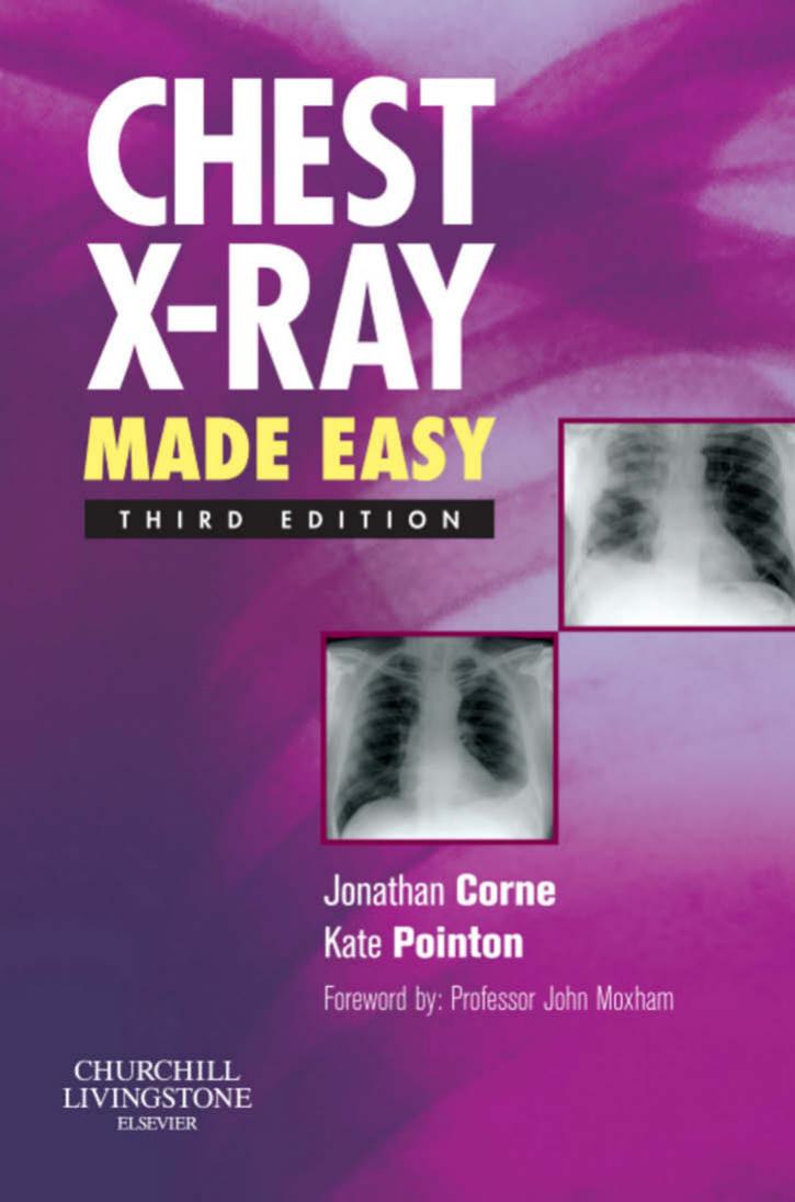 Chest x-ray made easy by Jonathan Corne; Kate Pointon