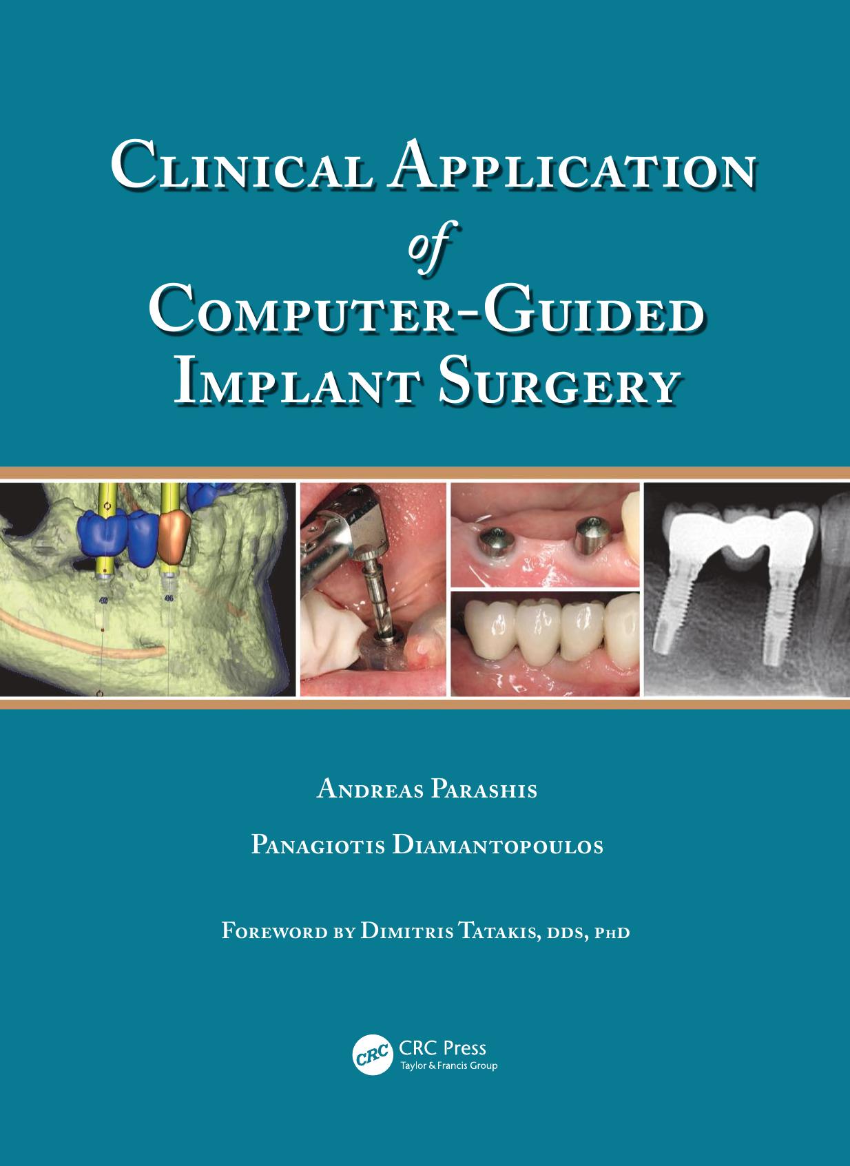 Clinical Application of Computer-Guided Implant Surgery by Unknow