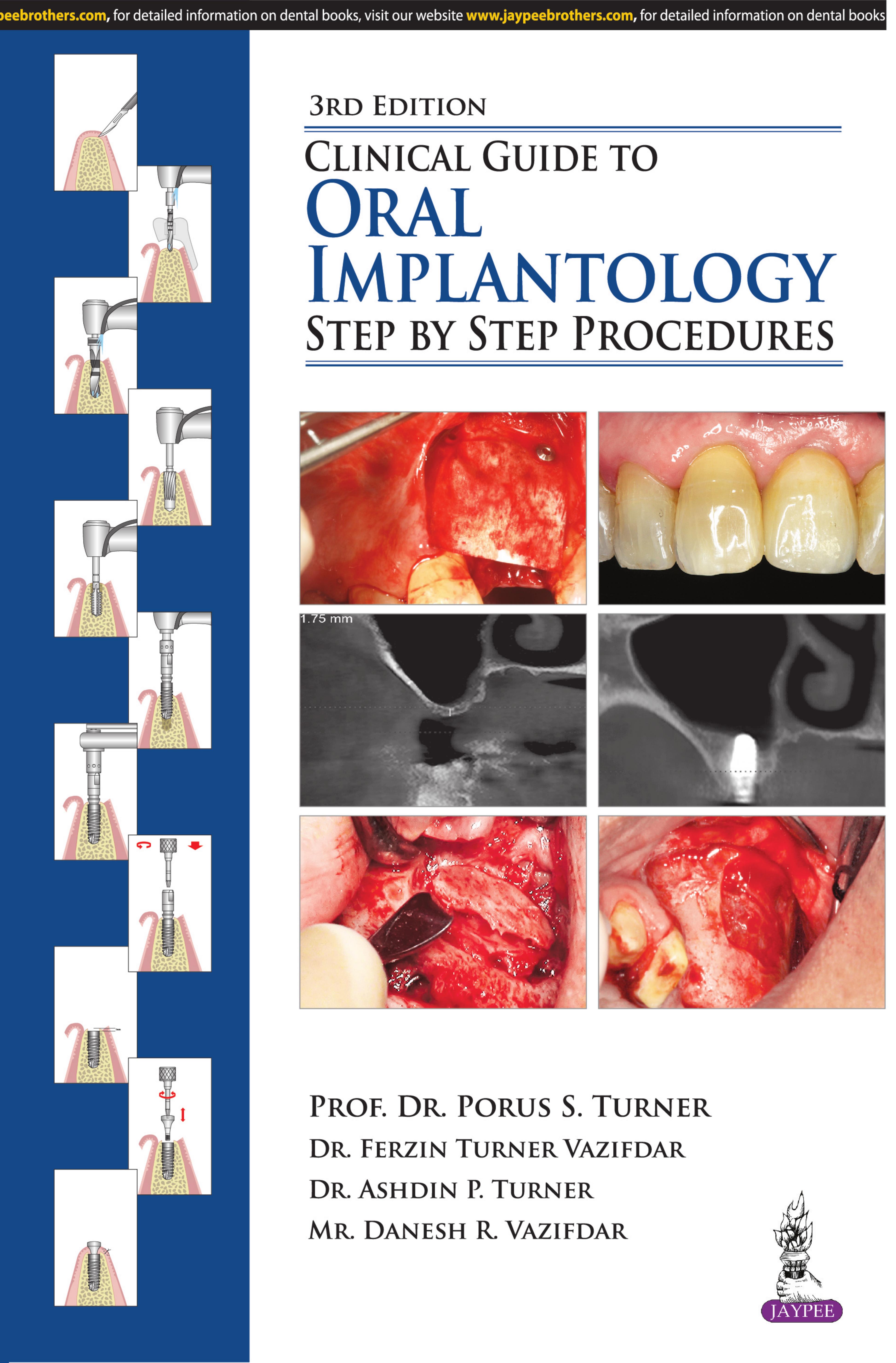 Clinical Guide to Oral Implantology: Step by Step Procedures by Porus S. Turner; Ferzin Turner Vazifdar; Ashdin P. Turner