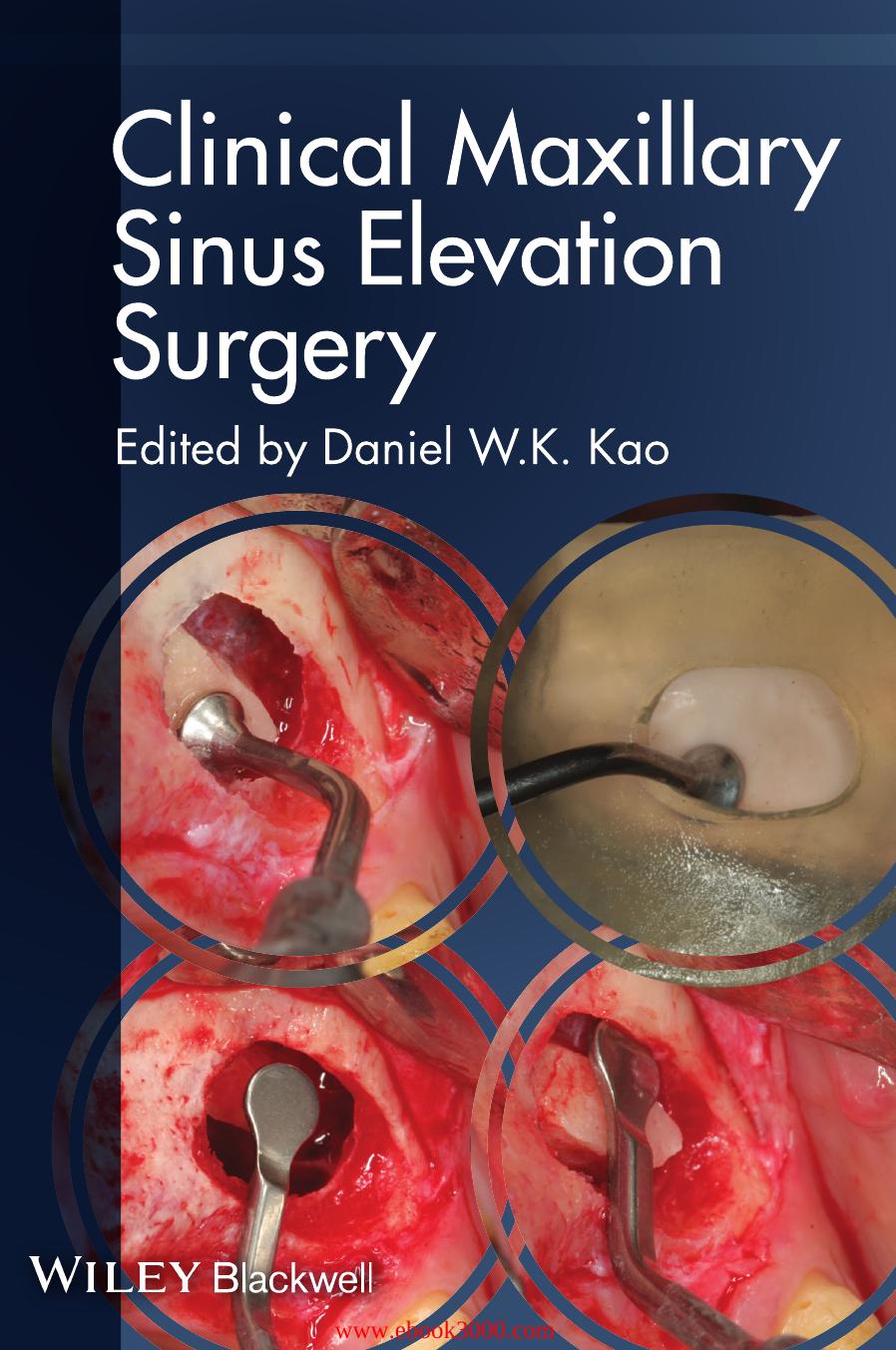 Clinical Maxillary Sinus Elevation Surgery by Unknow