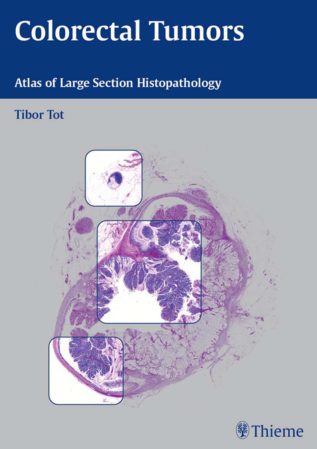 Colorectal tumors: atlas of large section histopathology by Tot Tibor