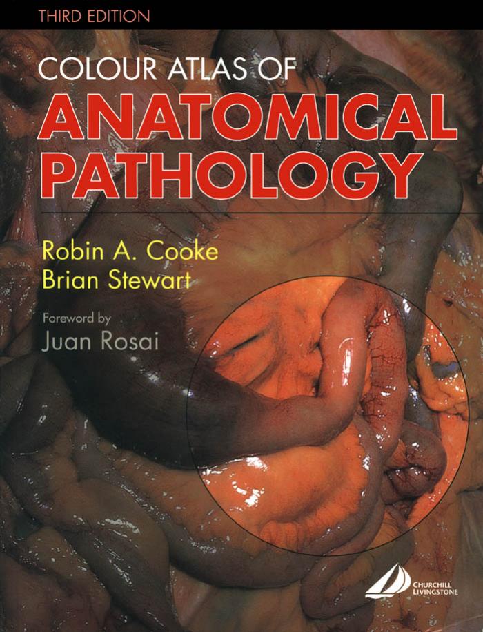 Colour Atlas of Anatomical Pathology by Robin A. Cooke Brian Stewart