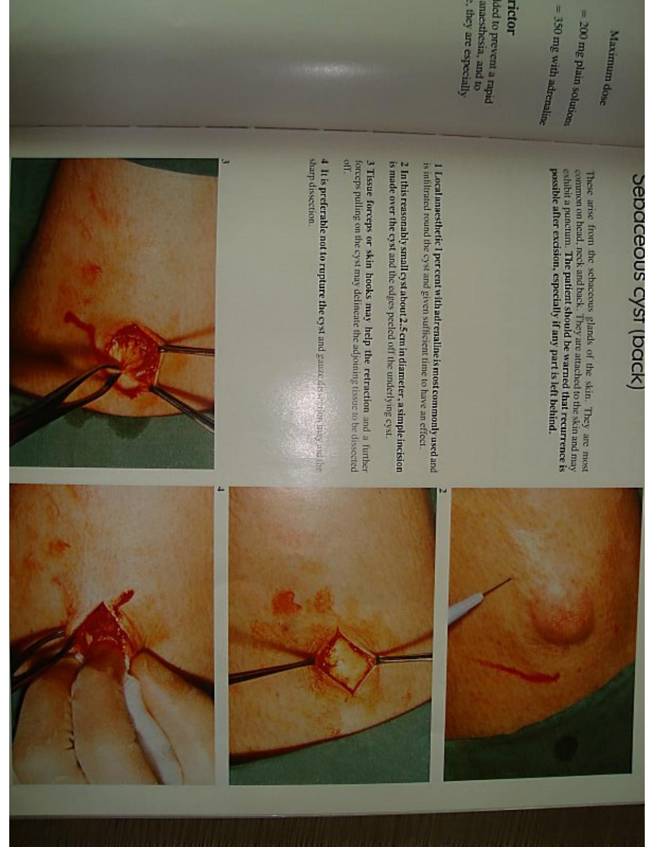 Colour Atlas of Minor Surgery by William F. Walker