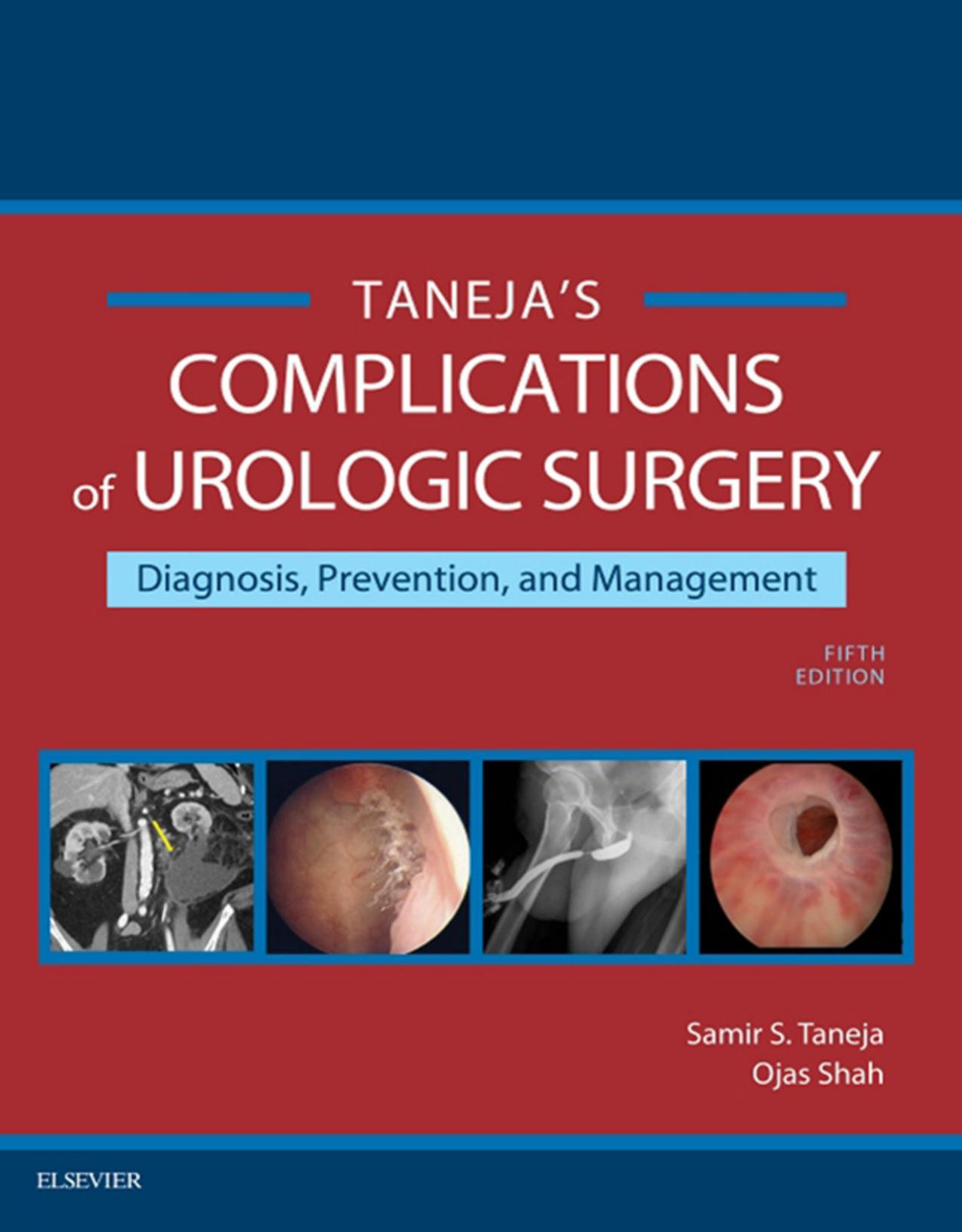 Complications of Urologic Surgery: Prevention and Management by Samir S. Taneja Ojas Shah