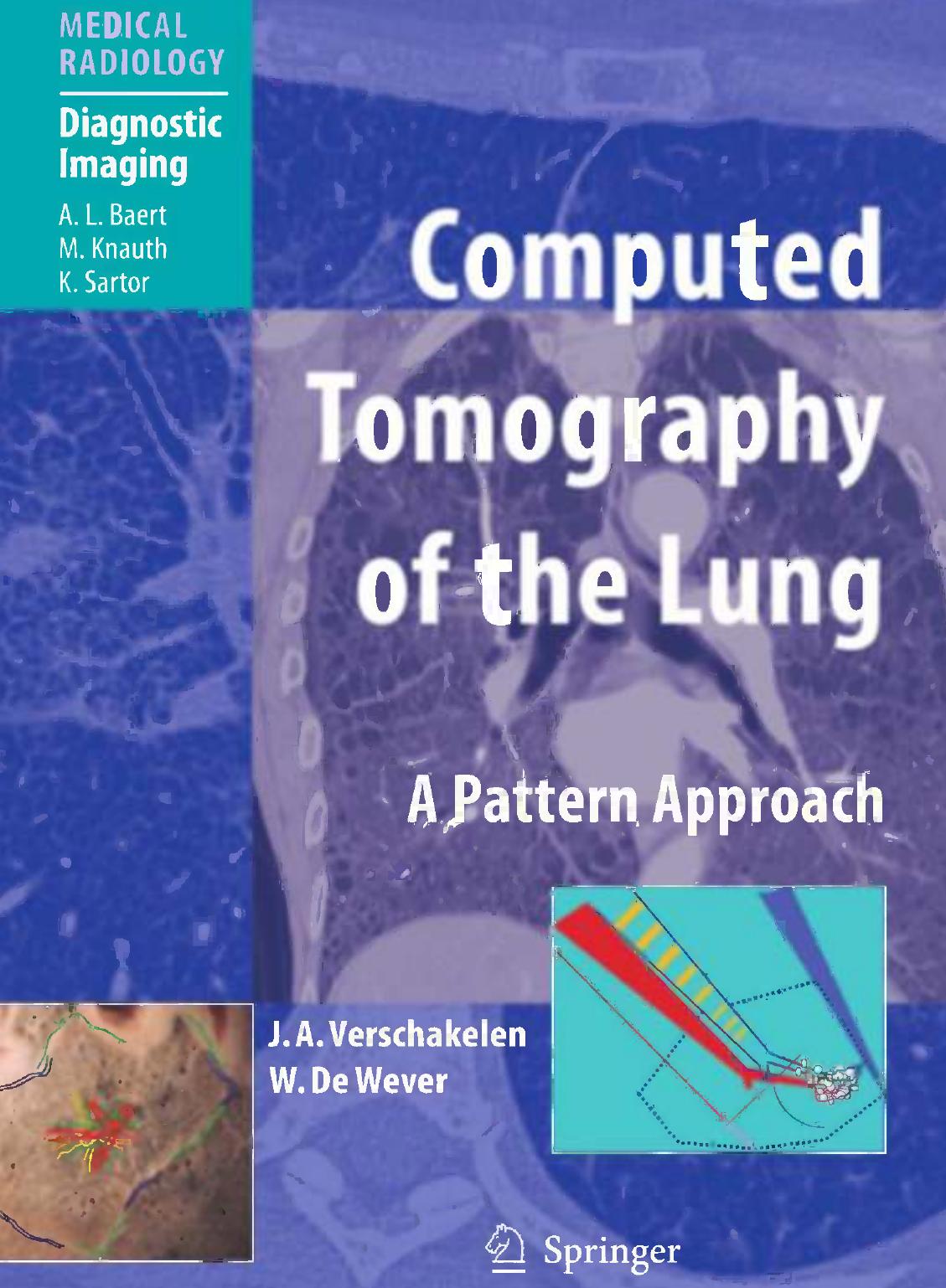 Computed Tomography of the Lung: A Pattern Approach by J. A. Verschakelen MD W. De Wever MD (auth.)