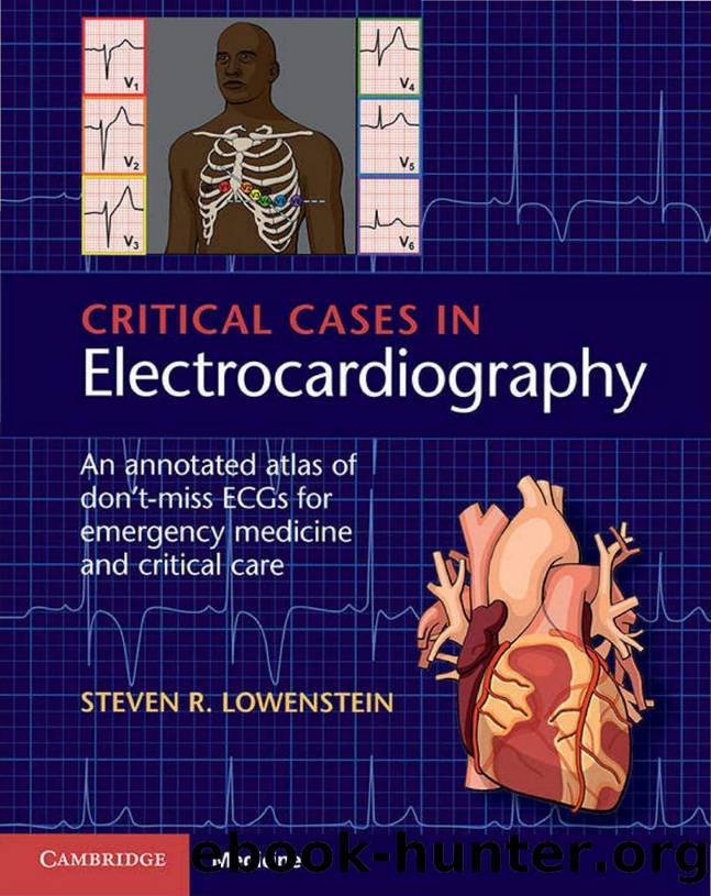 Critical Cases in Electrocardiography An Annotated Atlas of Donât by Unknown