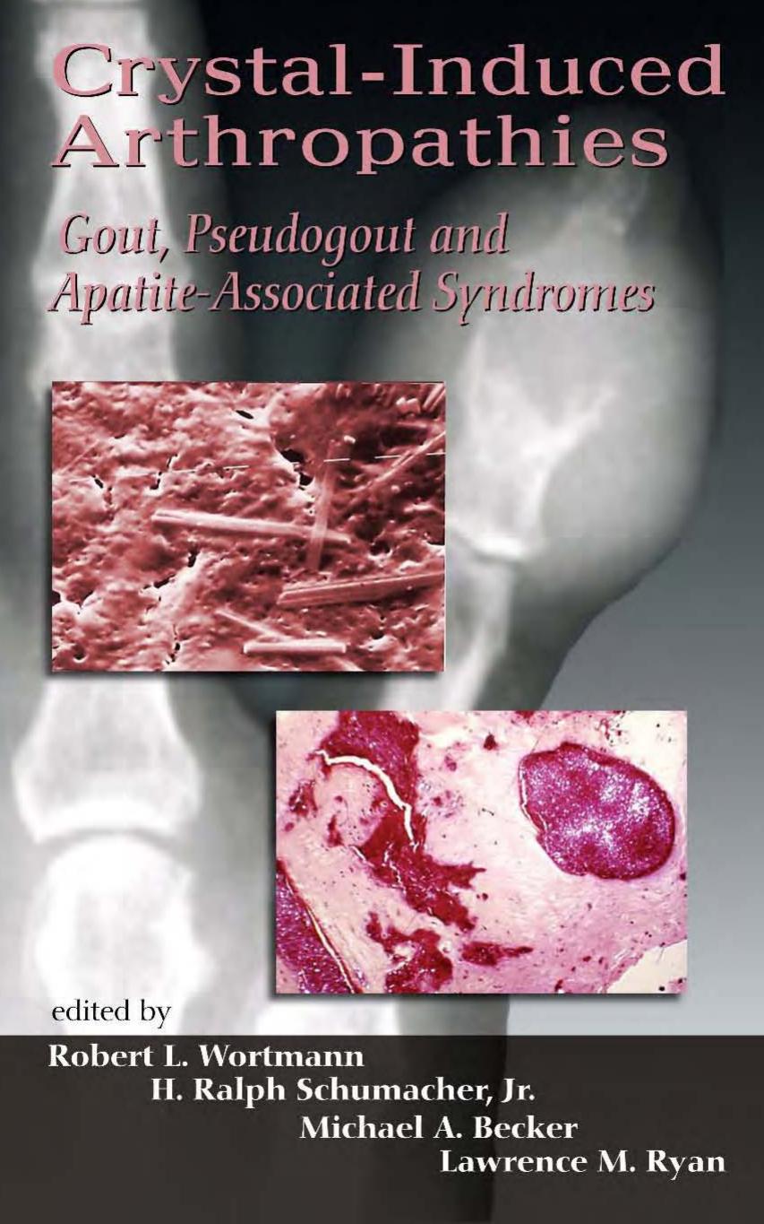 Crystal-Induced Arthropathies: Gout, Pseudogout and Apatite-Associated Syndromes by Robert L. Wortmann